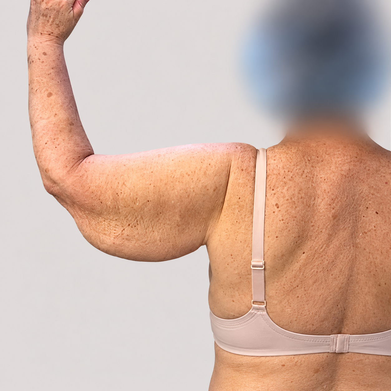 Before arm lift treatment