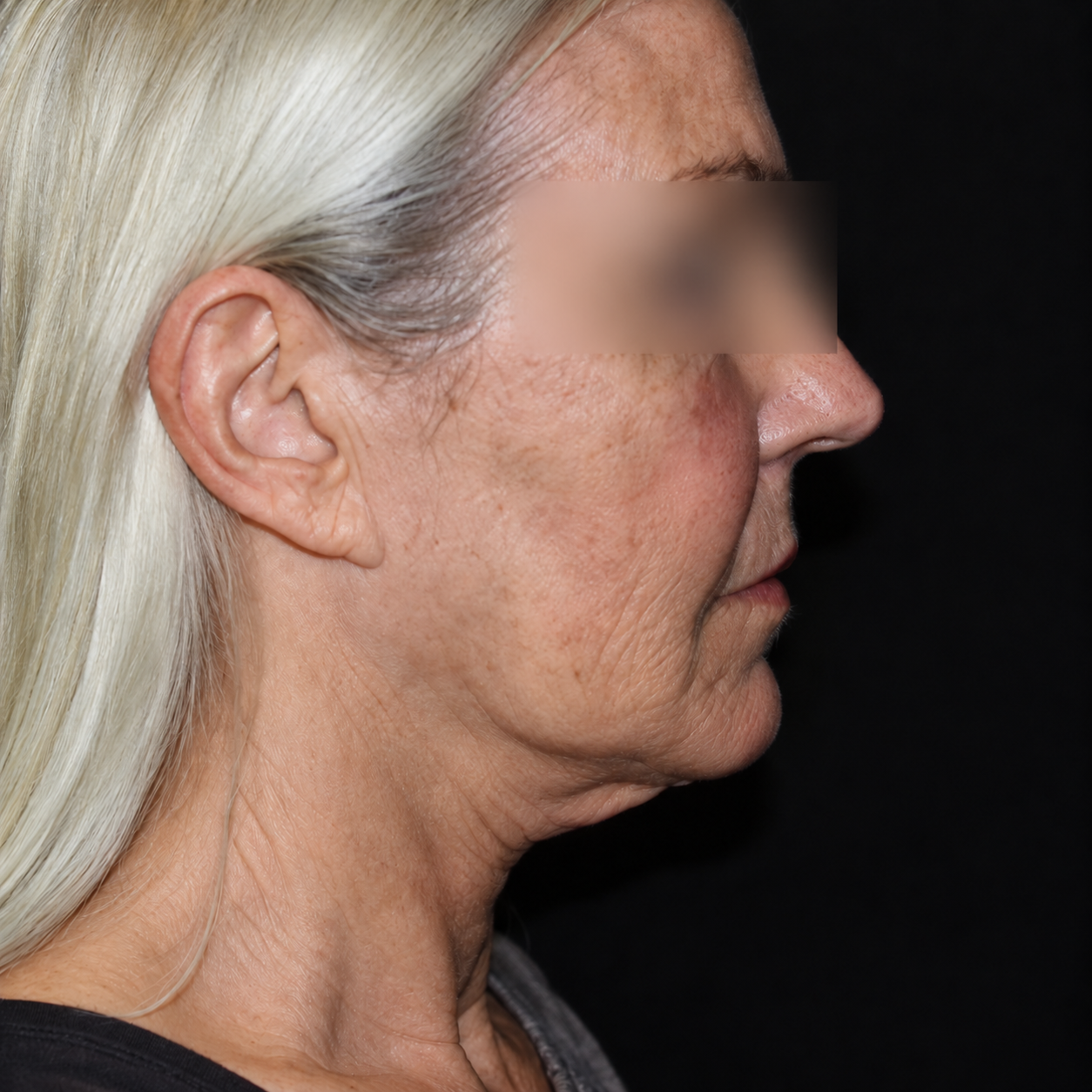Before facial rejuvenation treatment