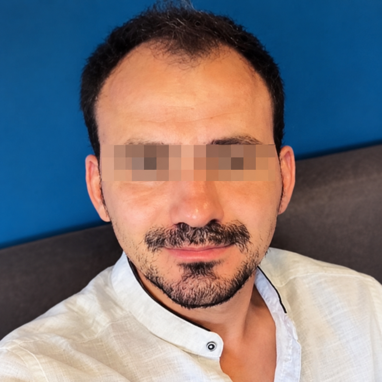 Hair transplant before treatment