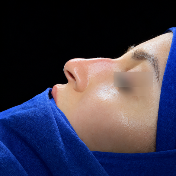 Before rhinoplasty treatment